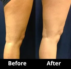 Before and After Image: Veins - right-back-oblique