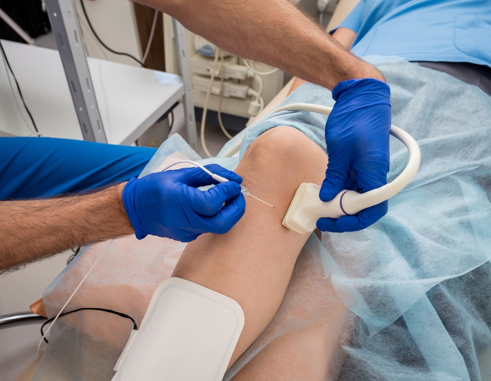 Patient receiving ultrasound guided radiofrequency ablation for leg veins.