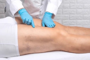 Patient lying flat and having their leg veins examined by a doctor, suffering from venous insufficiency.